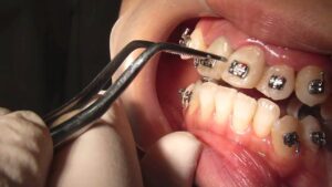 Orthodontics in Eluding Certain Systemic Diseases and Infections