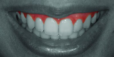 Gingival Zenith: A Collar To Be Proud About In Dentistry