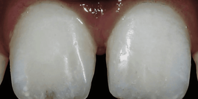 Using Direct Composite Resin for Posterior & Anterior Esthetic Restorations  - A Case Series