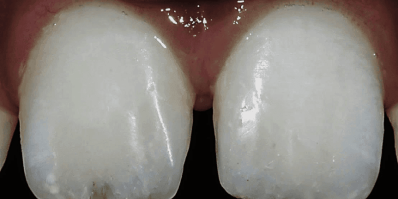 Using Direct Composite Resin for Posterior & Anterior Esthetic Restorations  - A Case Series