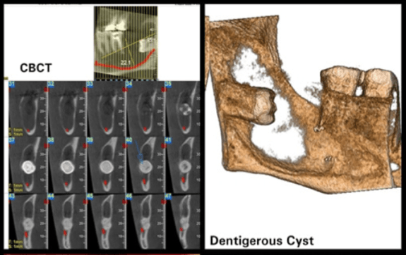 Surgical Management Of Mandibular Dentigerous Cyst – A Case Report