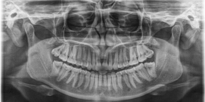 Diagnostic Blocks in Orofacial Pain - A Case Report