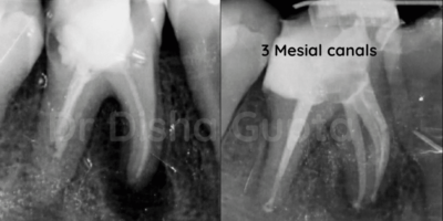 Management of Extra Oral Sinus tract Associated With Large Periapical Lesion - A Case Report