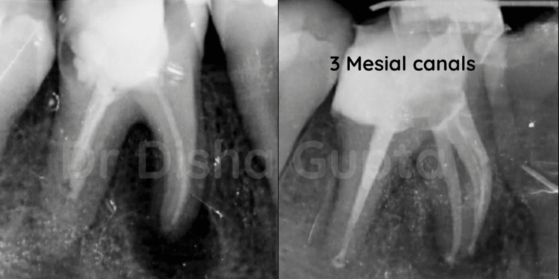Management of Extra Oral Sinus tract Associated With Large Periapical Lesion - A Case Report