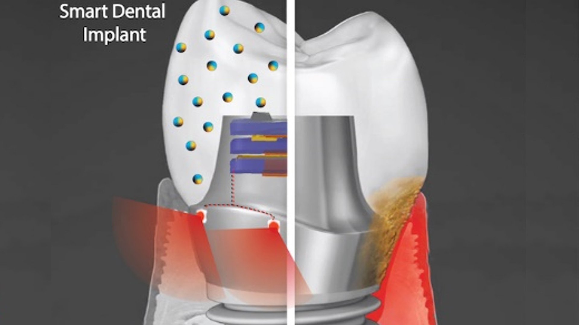 Smart Dental Implants To Resist Bacterial Growth By Generating Electricity
