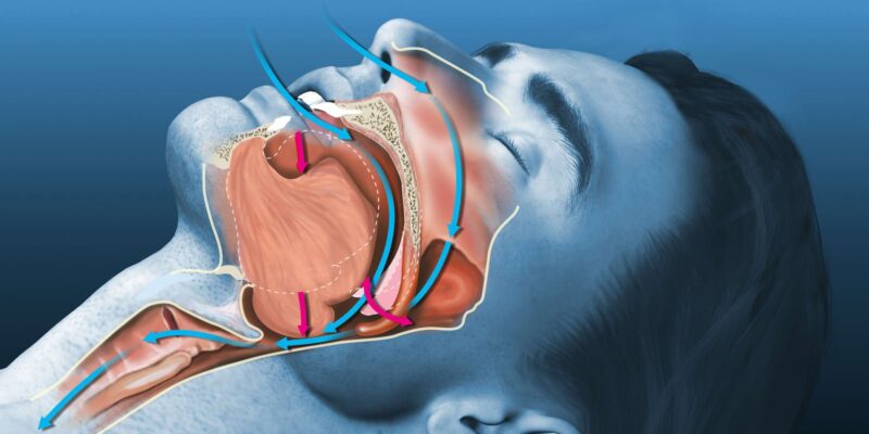 Obstructive Sleep Apnea : Role Of A Dental Surgeon