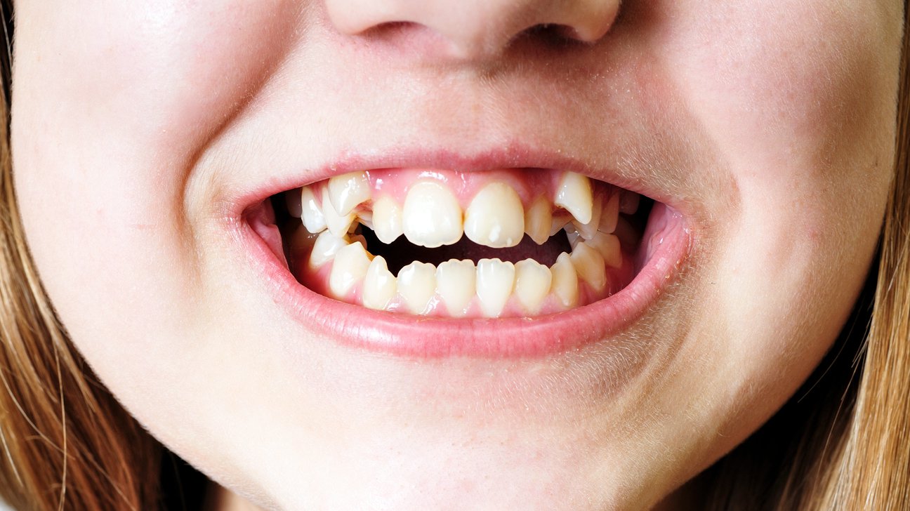 DIY Braces are Crooked for Your Teeth!