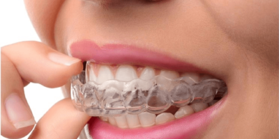 Why To Add Clear Braces In Your Practice?
