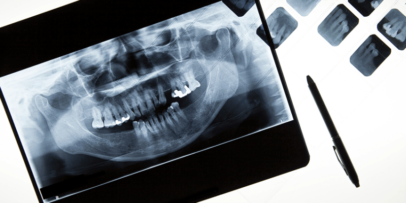 Dental X-Rays Causing More Harm Than Good?