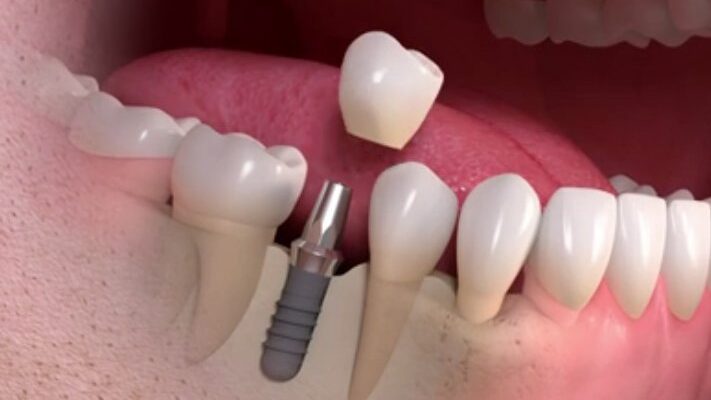 Bio-Engineered teeth Replacement Comes Closer To Reality