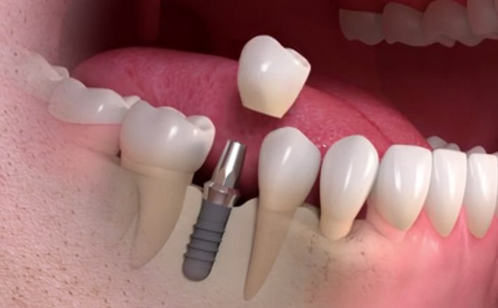 Bio-Engineered teeth Replacement Comes Closer To Reality