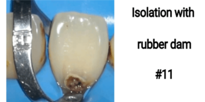 Single Visit Tooth Build Up And Esthetic Rehabilitation Of Carious Class V In Upper Front Central Incisor