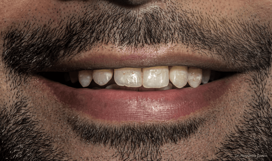 Biomimetic Rehabilitation of Multiple Teeth with Interdental Spacing