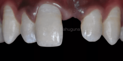 Fragment Re-Attachment - Preserve and Conserve