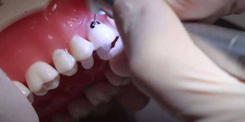 Success with Class V restorations in day to day dentistry!