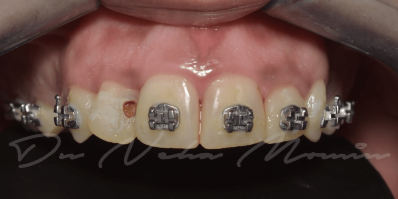 Case Report: Lifelike Restoration with Mineral Enriched Activa™ Pronto