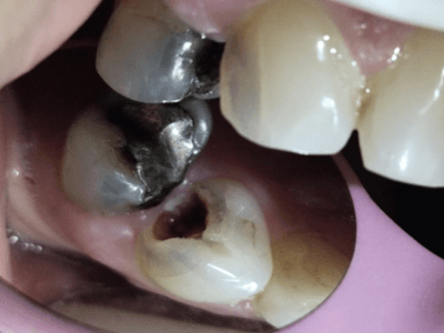 Anterior Esthetic Restoration with DME using Activa™ Pronto - A Case Report