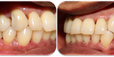 Saving teeth ‘Activa-ly’!