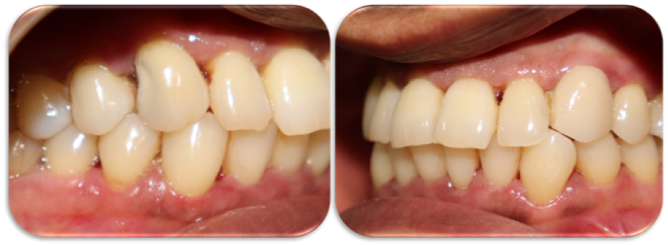 Saving teeth ‘Activa-ly’!