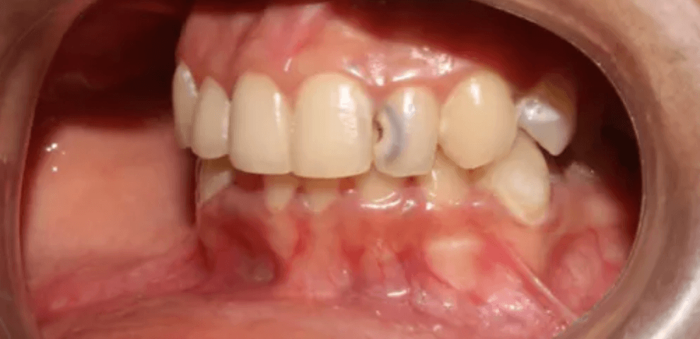 Management of deep Class III caries for a healthy and happy smile