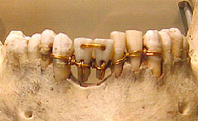 ‘I’m-planted’ 4000 years ago! - A history of dental implants before titanium cover