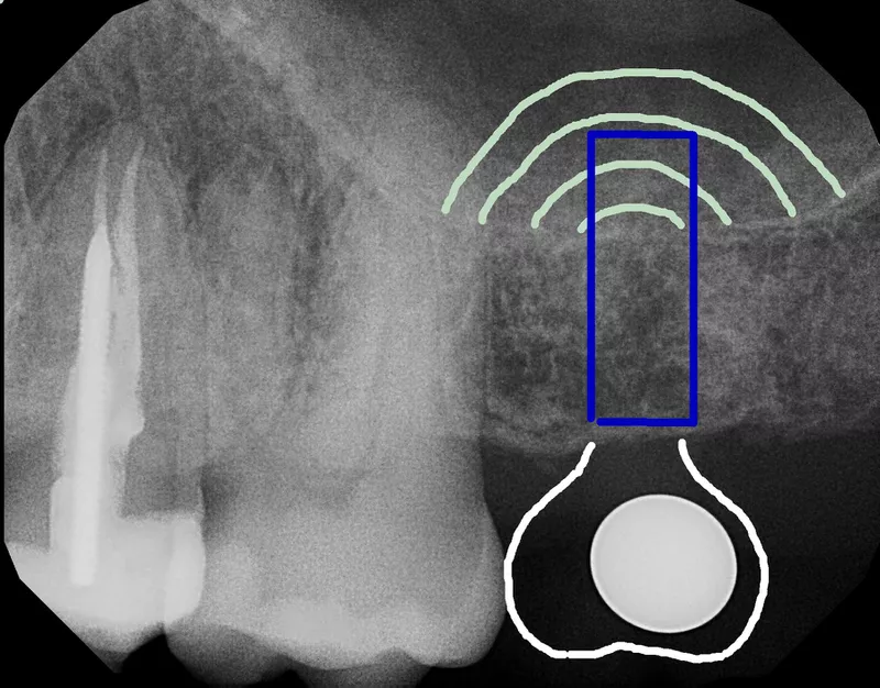 Osseodensification and crestal sinus grafting for dental implants in posterior maxilla: A case report cover