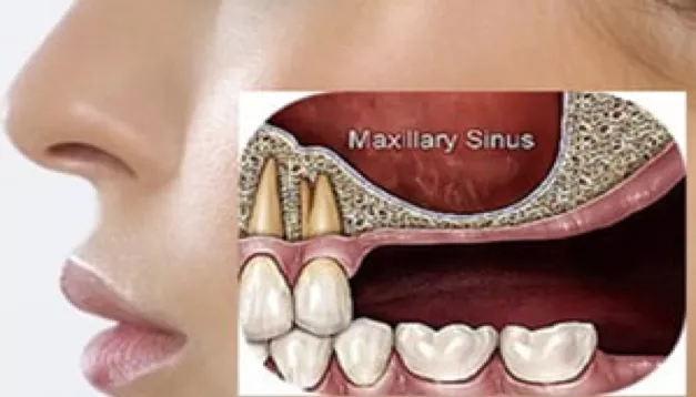 Direct sinus lift using composite bone graft in implant dentistry: a pictorial case report cover