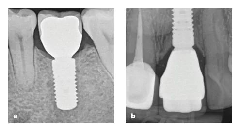 The ‘zero bone loss’ concept in implant dentistry cover