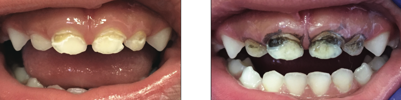 Smaller Teeth Pose Bigger Problems!, DentalReach - Leading Dental Magazine - Dentistry Journal, News &amp; Events