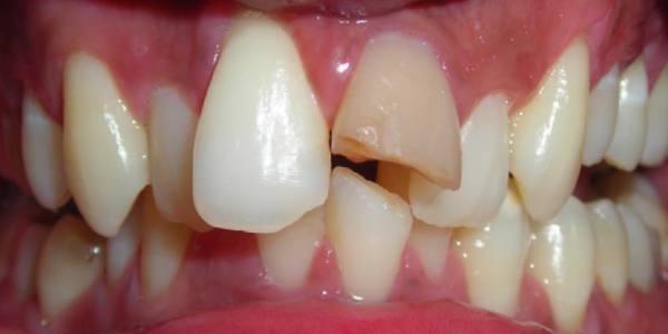 Micro Surgical Management Of A Long Standing Radicular Cyst 4459