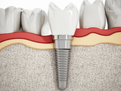 Impact of osteoporosis on dental implants cover