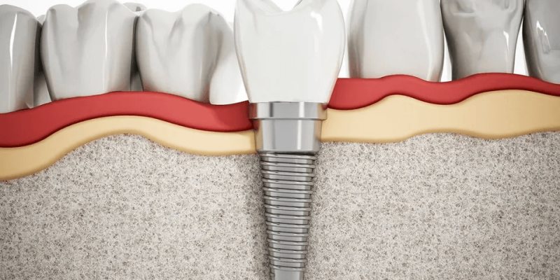 Impact of osteoporosis on dental implants cover