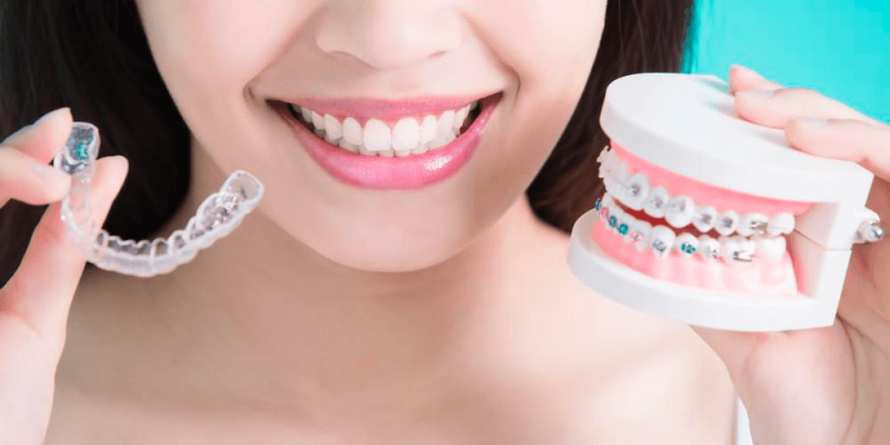 Are Clear Aligners Better than the Conventional Orthodontic Treatment? cover