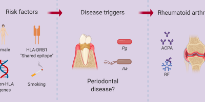 Periodontitis Unveils Deeper Relationship to Rheumatoid Arthritis cover