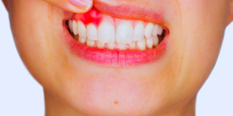Topical Gel Treatment To Revolutionize The Way We Treat Gum Disease cover