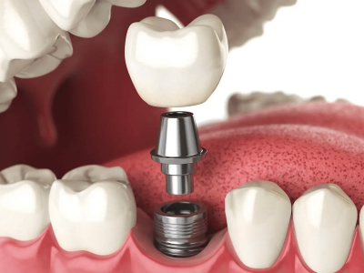 10 tips you can tell your patient post dental implant treatment cover