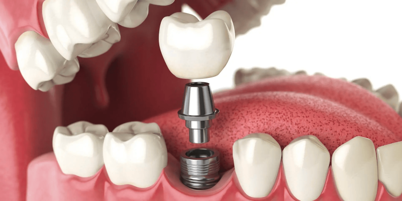 10 tips you can tell your patient post dental implant treatment cover