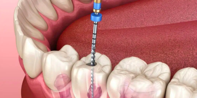 10 Post RCT Dental Care Tips You Can Tell Your Patients cover