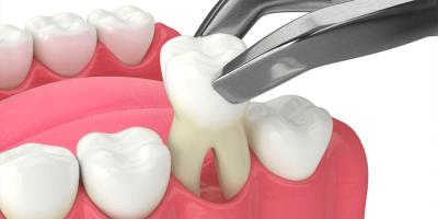 10 Post Extraction Dental Care Tips You Can Tell Your Patients cover