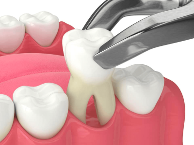 10 Post Extraction Dental Care Tips You Can Tell Your Patients cover