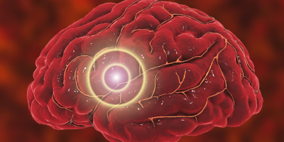 Increased Burden of Cerebrovascular Disease Linked to Poor Oral Health cover