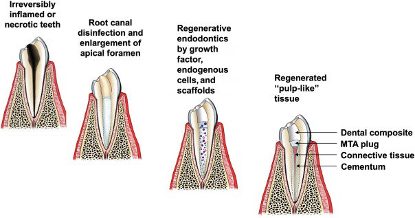 Cell Homing: A Game-Changer for Regenerative Endodontics? cover