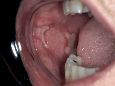 A Silent Threat: How Oral Mucosal Damage can Trigger Rheumatoid Arthritis? cover