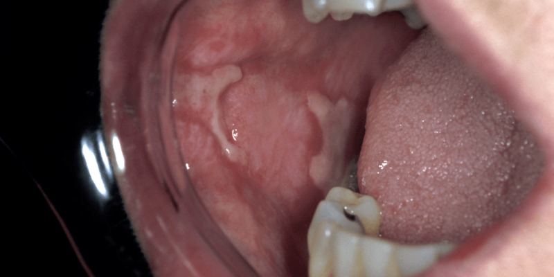 A Silent Threat: How Oral Mucosal Damage can Trigger Rheumatoid Arthritis? cover