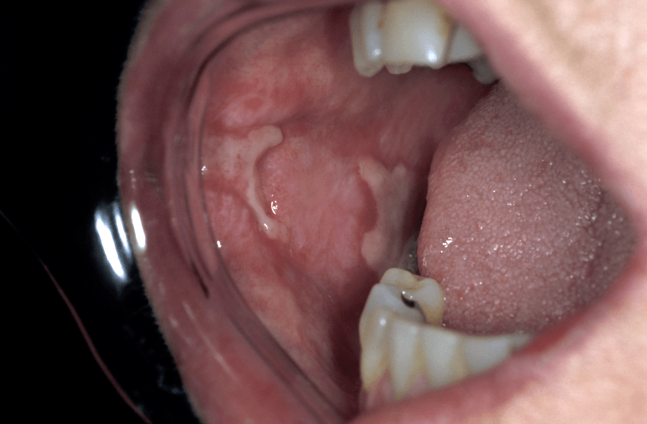 A Silent Threat: How Oral Mucosal Damage can Trigger Rheumatoid Arthritis? cover