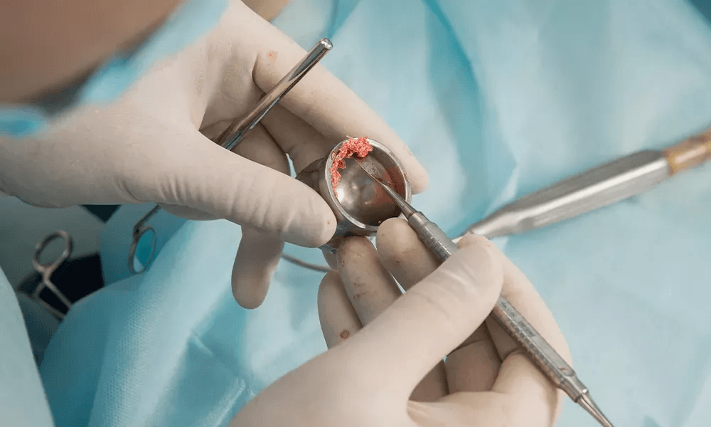 Endodontic Grafts: A Comprehensive Guide for Dental Practitioners cover