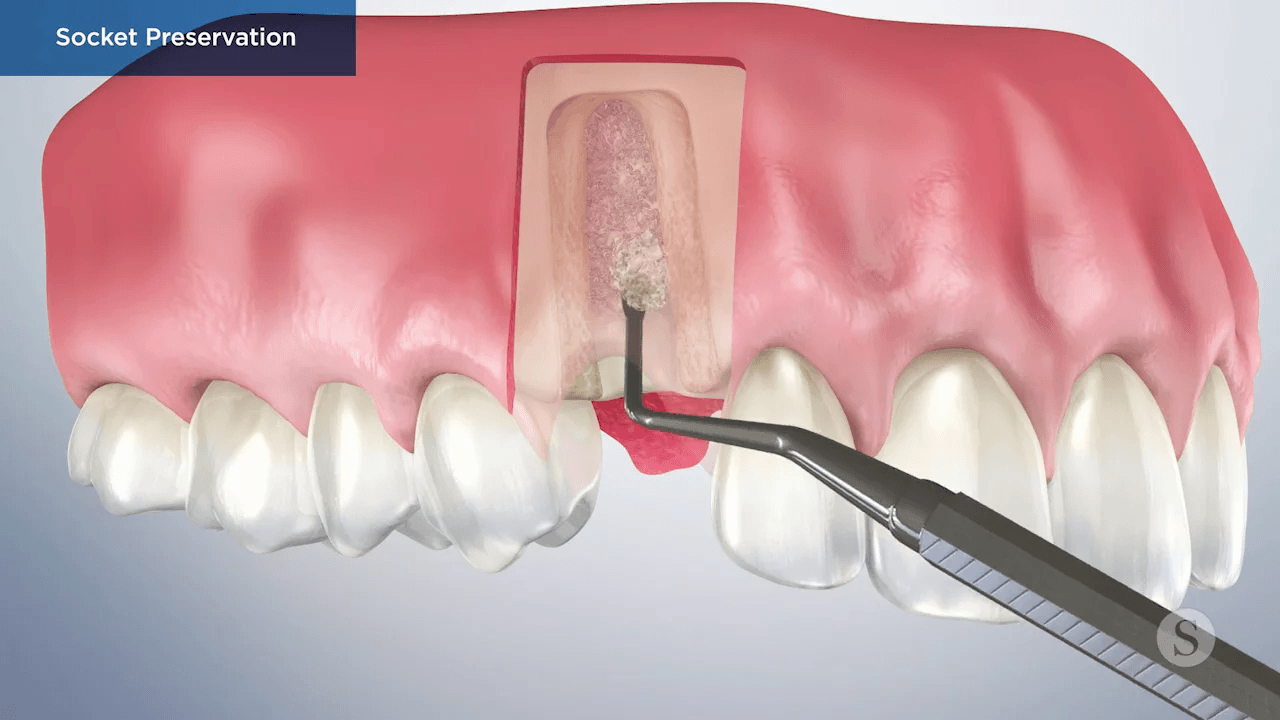 Extraction Socket Preservation: When, why, how? cover