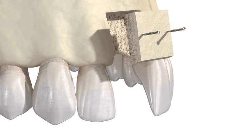 Bone Substitutes In Implantology: A Review cover