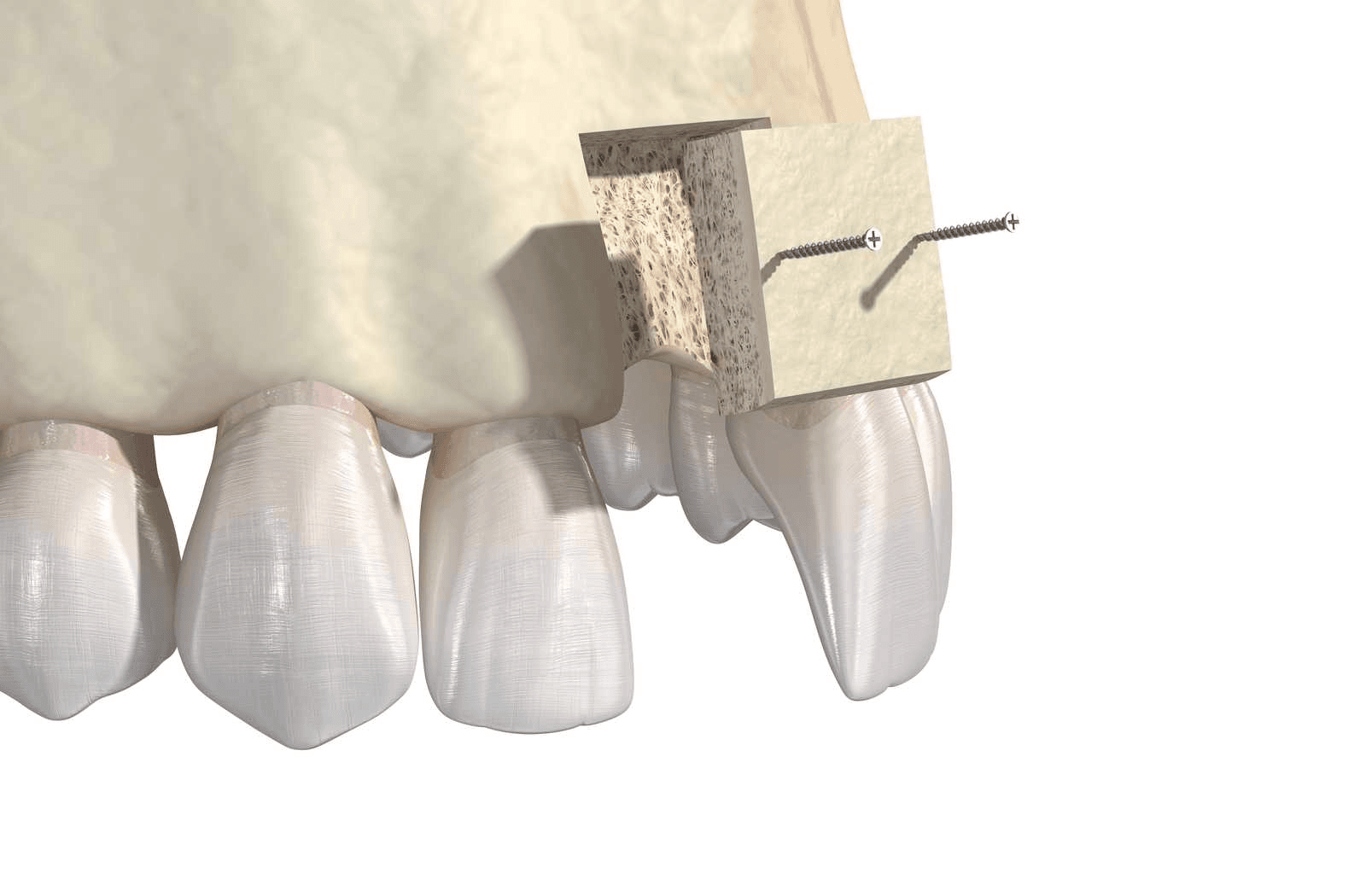 Bone Substitutes In Implantology: A Review cover