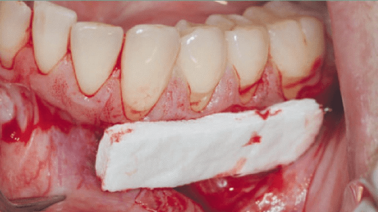 Mucograft® as an Alternative Treatment in the Management of Multiple Gingival Recessions: A Case Report cover